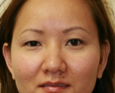Feel Beautiful - Eyelid Surgery San Diego Case 42 - Before Photo